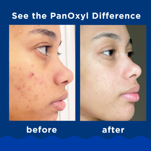 Panoxyl – Acne Foaming Wash Benzoyl Peroxide 10% Maximum Strength