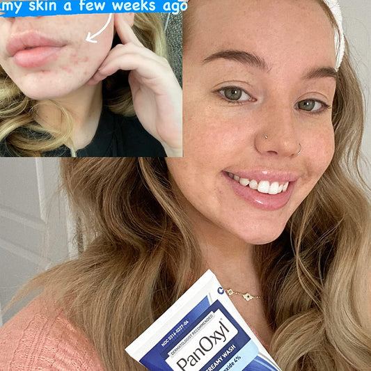 Panoxyl – Acne Creamy Wash Benzoyl Peroxide 4% Daily Control
